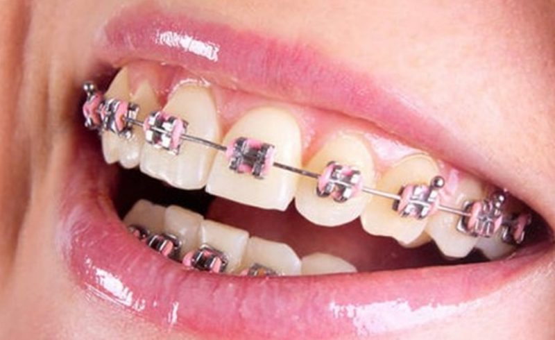 Estetik Dişler İçin Ortodonti